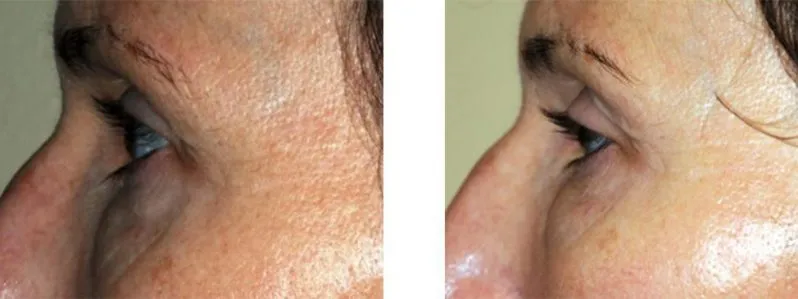 skin tightening case study