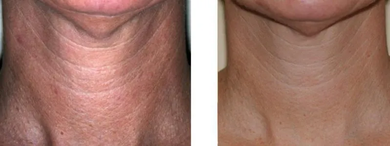 skin tightening case study