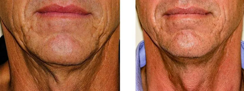 skin tightening case study